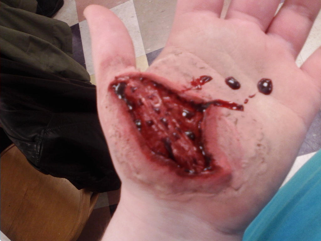 نتیجه تصویری برای ‪Hand wound‬‏